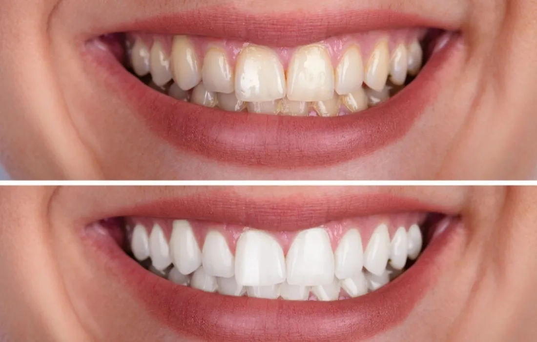 Clareamento dental