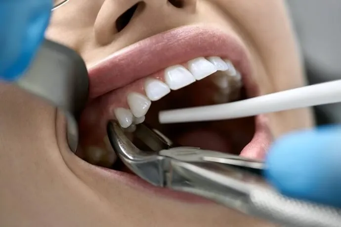 Extração dental