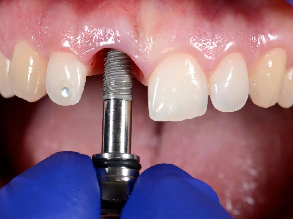 Implante dentário