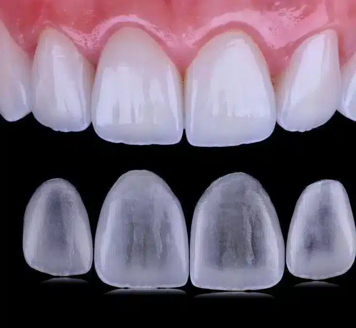 Lentes de contato dental