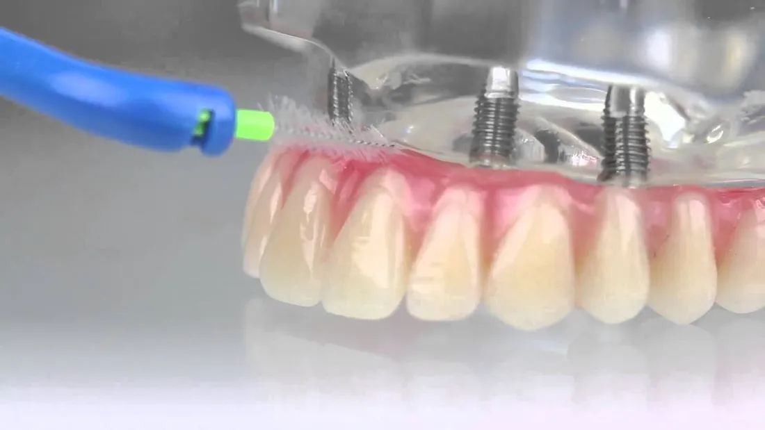 Limpeza de prótese protocolo
